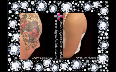 Quick and effective tattoo removal of skulls and roses in full color