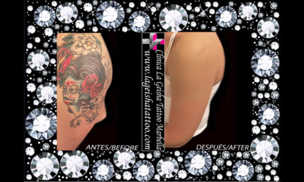 Quick and effective tattoo removal of skulls and roses in full color