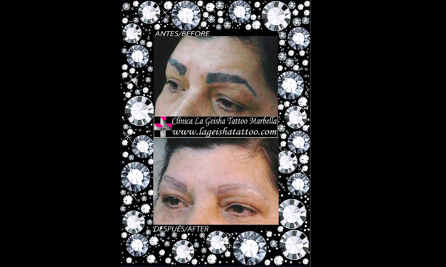 Magic eyebrows micropigmentation removal in just one session
