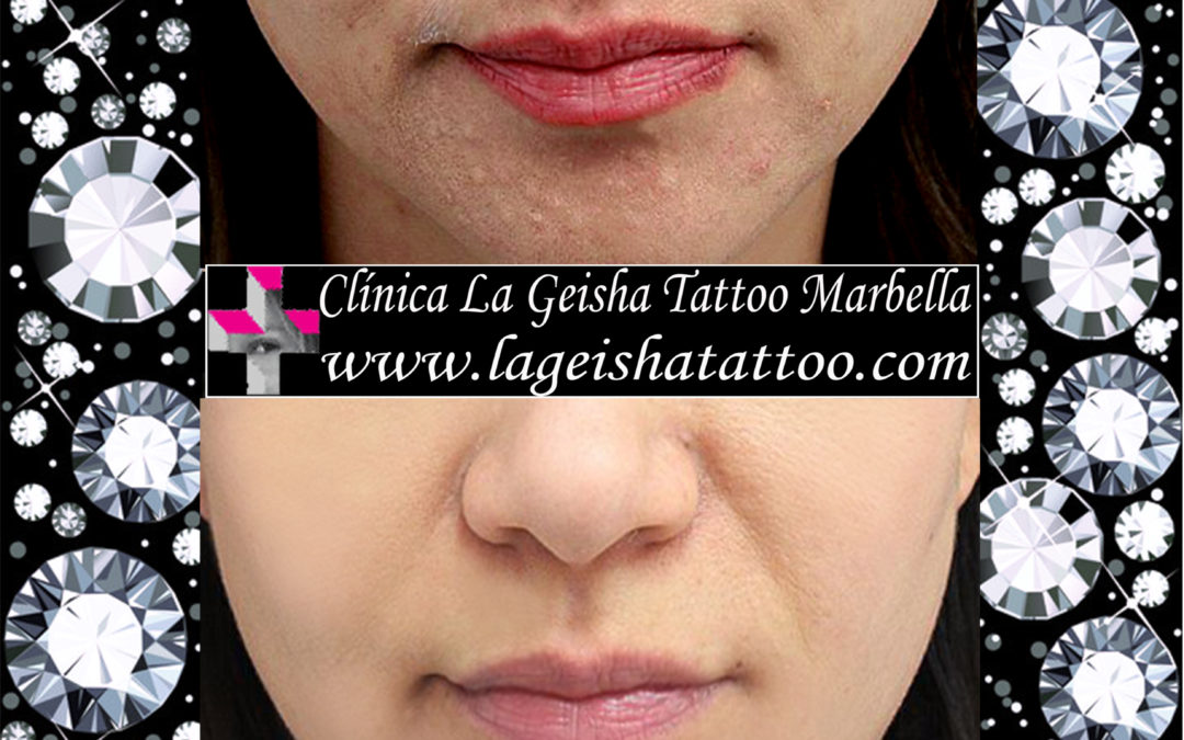 Incredible lips permanent make up removal and spots removal