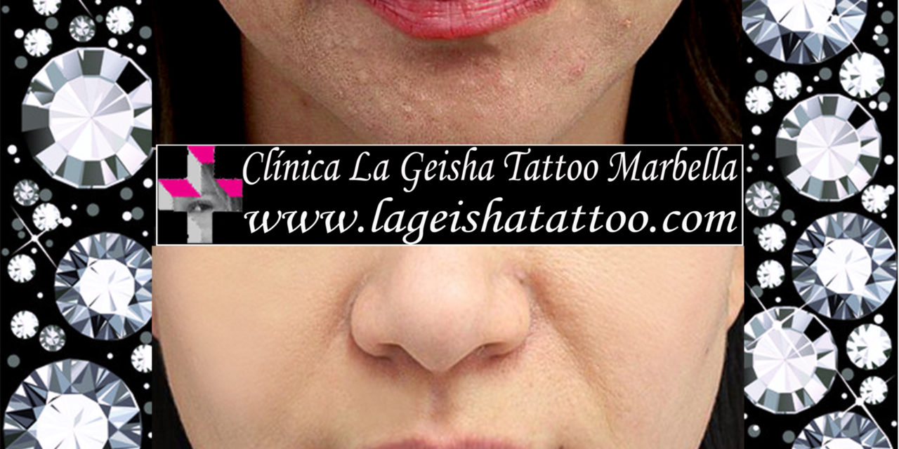 Incredible lips permanent make up removal and spots removal