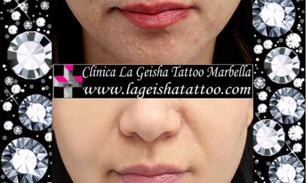 Incredible lips permanent make up removal and spots removal